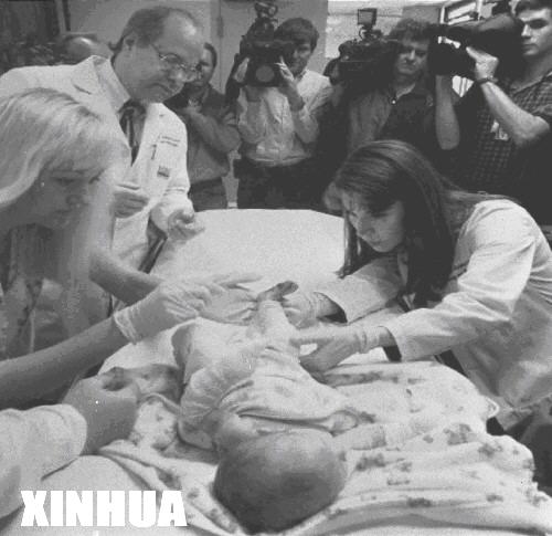 接受活性人体细胞和牛胶原蛋白合成皮肤移植的第一例病人（历史上今天todayonhistory.com）